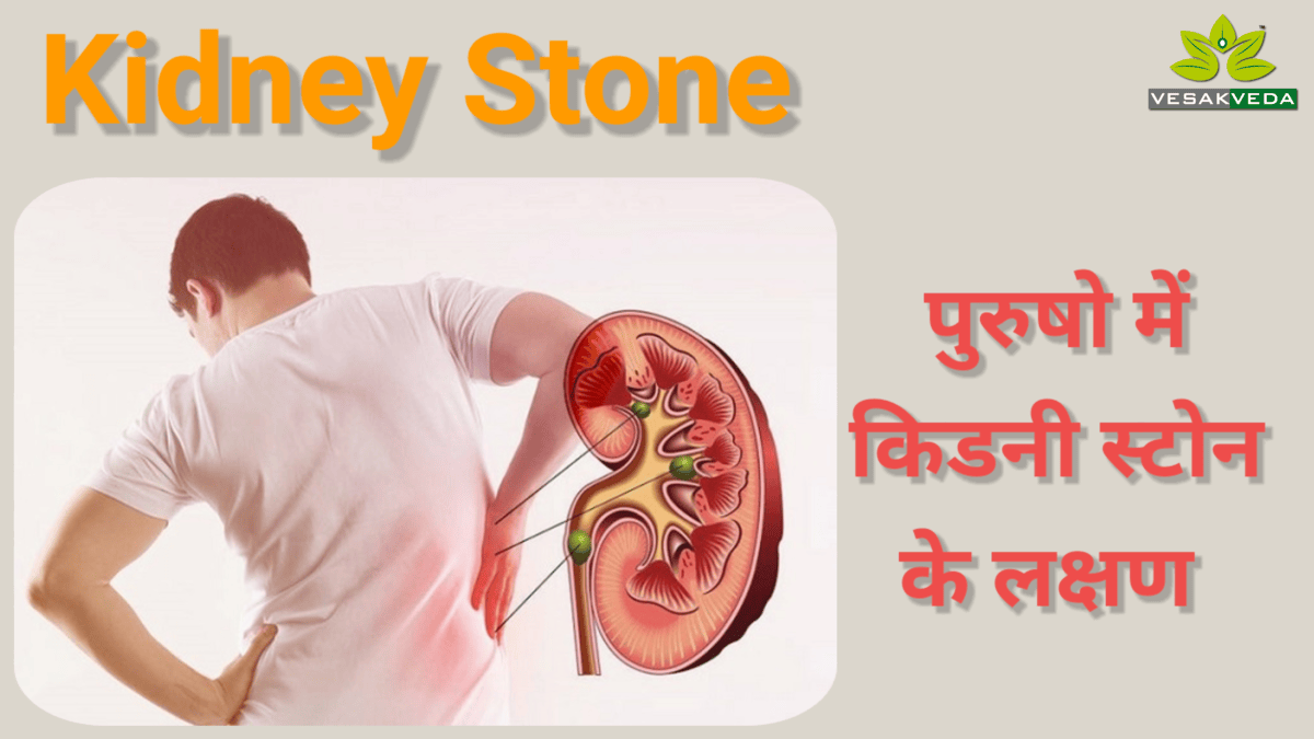 Kidney Stone